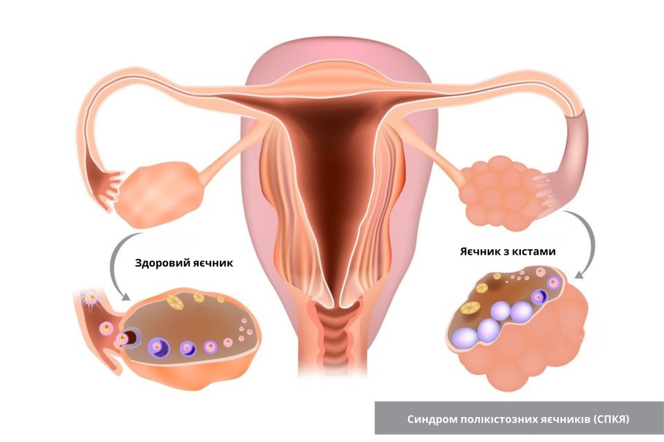 Що таке кіста яєчника і як вона виглядає